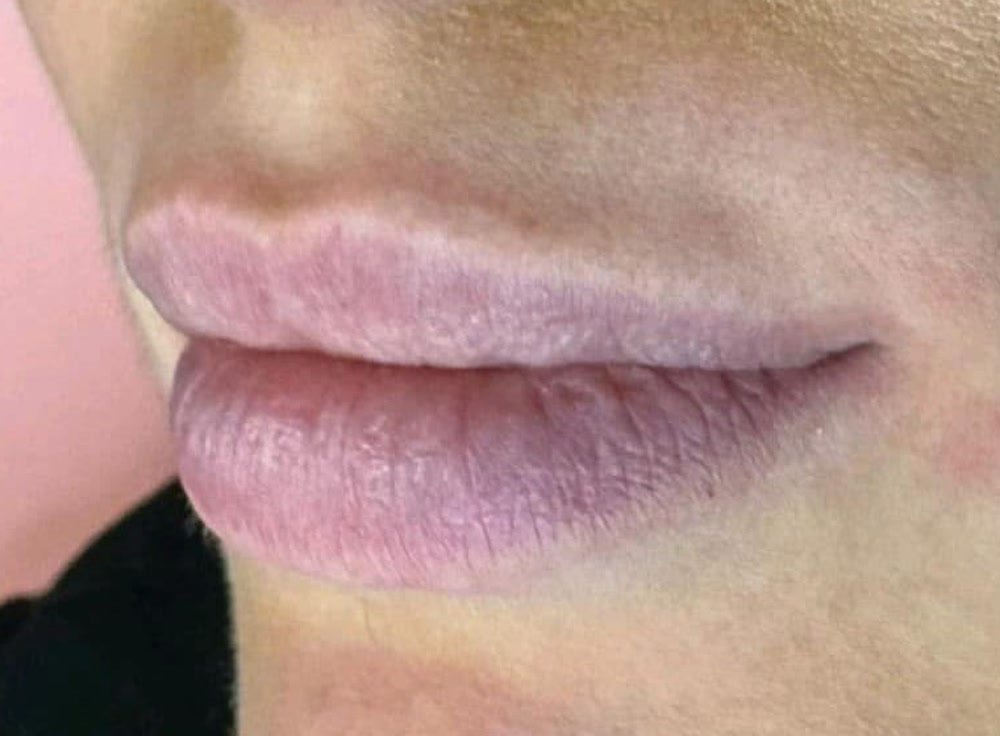 Lips before treatment, pale and undefined.